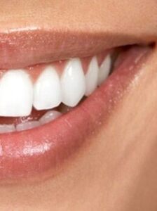 Скидка 25% на лазерное отбеливание зубов