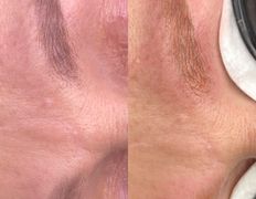 null Студия перманентного макияжа Алексея Набедо, Удаление перманентного макияжа - фото 3