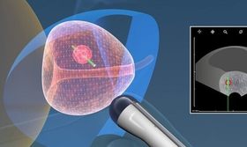 Биопсия предстательной железы