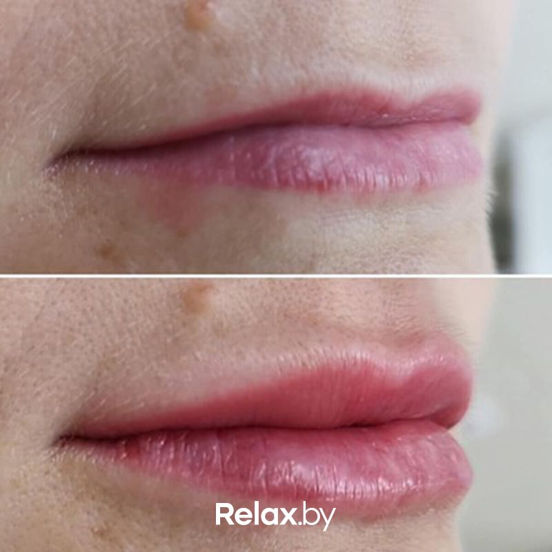 Инъекционные процедуры Салон красоты «ORIENTAL (Ориентал)» - фото 7822129