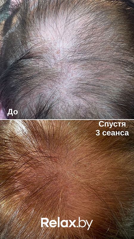 Холодная плазма Студия красоты «INTUITION (Интуишн)» - фото 7838278