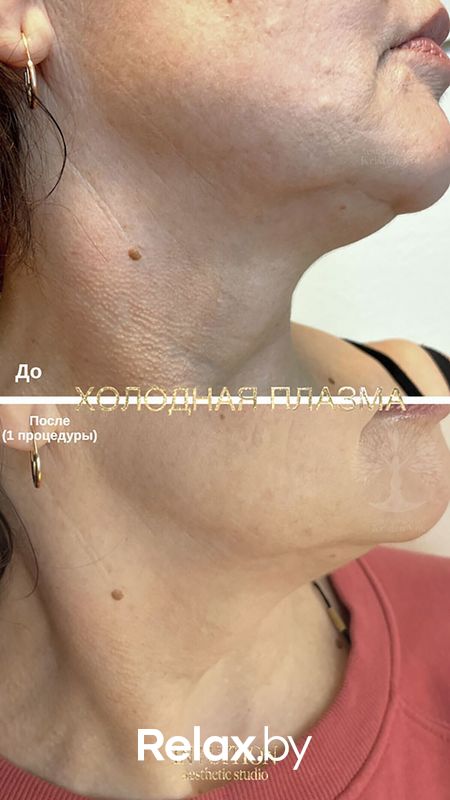 Холодная плазма Студия красоты «INTUITION (Интуишн)» - фото 7838281