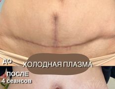 Студия красоты INTUITION (Интуишн), Холодная плазма - фото 6