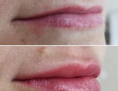 Салон красоты ORIENTAL (Ориентал), Инъекционные процедуры - фото 6