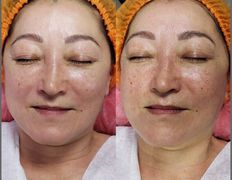 Студия красоты Valeria Studio (Валерия Студия), Уход за лицом - фото 8