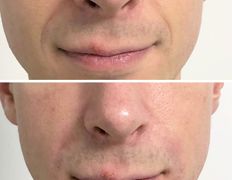 Салон красоты ORIENTAL (Ориентал), Инъекционные процедуры - фото 9