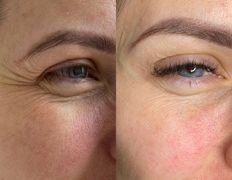 Салон красоты ORIENTAL (Ориентал), Инъекционные процедуры - фото 4