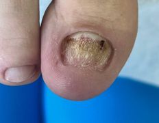 Студия подологии и эстетики  Moipodolog (Мой подолог), Подология - фото 20