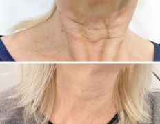 Салон красоты ORIENTAL (Ориентал), Инъекционные процедуры - фото 7