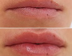 Салон красоты ORIENTAL (Ориентал), Инъекционные процедуры - фото 8