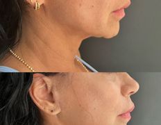 Салон красоты ORIENTAL (Ориентал), Инъекционные процедуры - фото 1