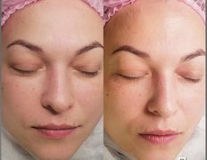 Студия красоты Valeria Studio (Валерия Студия), Уход за лицом - фото 10