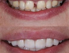 Стоматология Триомед, Примеры работ (ортопедия) - фото 3