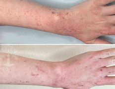 Студия красоты INTUITION (Интуишн), Холодная плазма - фото 4