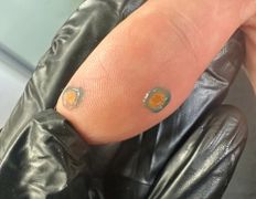 Центр подологии и эстетики Чистая стопа, Подология - фото 3