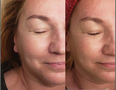 Студия красоты Valeria Studio (Валерия Студия), Уход за лицом - фото 9