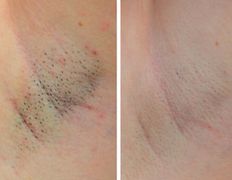 Салон красоты ORIENTAL (Ориентал), Александритовая лазерная эпиляция - фото 6