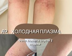 Студия красоты INTUITION (Интуишн), Холодная плазма - фото 5