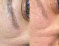 null Студия перманентного макияжа Алексея Набедо, Удаление перманентного макияжа - фото 4