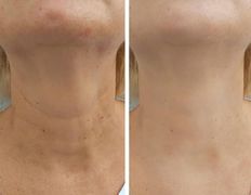 Салон красоты ORIENTAL (Ориентал), Инъекционные процедуры - фото 3