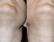 Салон красоты ORIENTAL (Ориентал), Александритовая лазерная эпиляция - фото 7