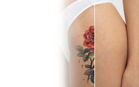 Удаление татуировок, пигментных пятен и омоложение кожи PICO-секундным лазером